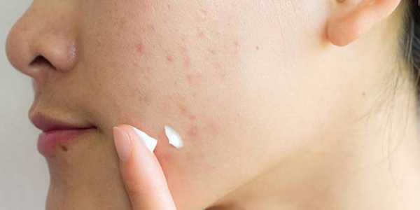 How to Treat Acne-Prone Skin Effectively?